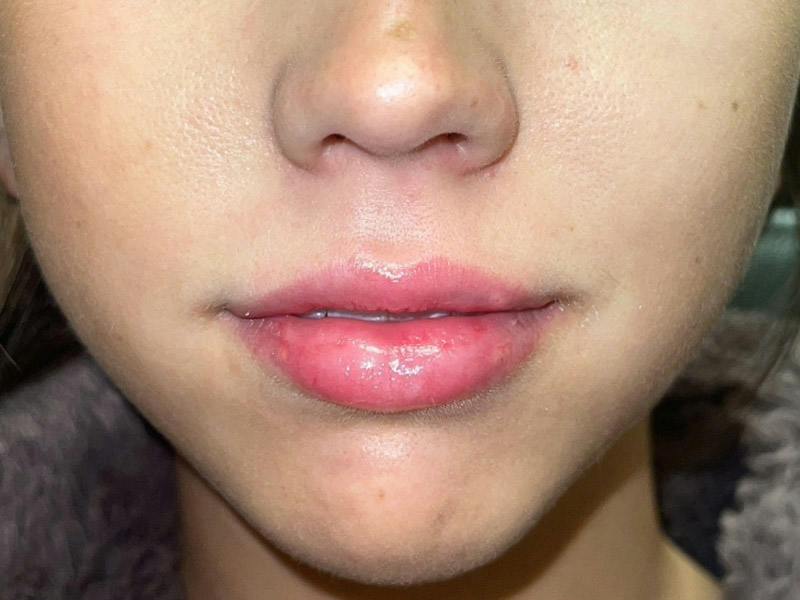 Lip Filler Before & After Gallery - Patient 186274 - Image 2