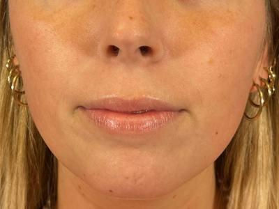 Lip Filler Before & After Gallery - Patient 369099 - Image 1