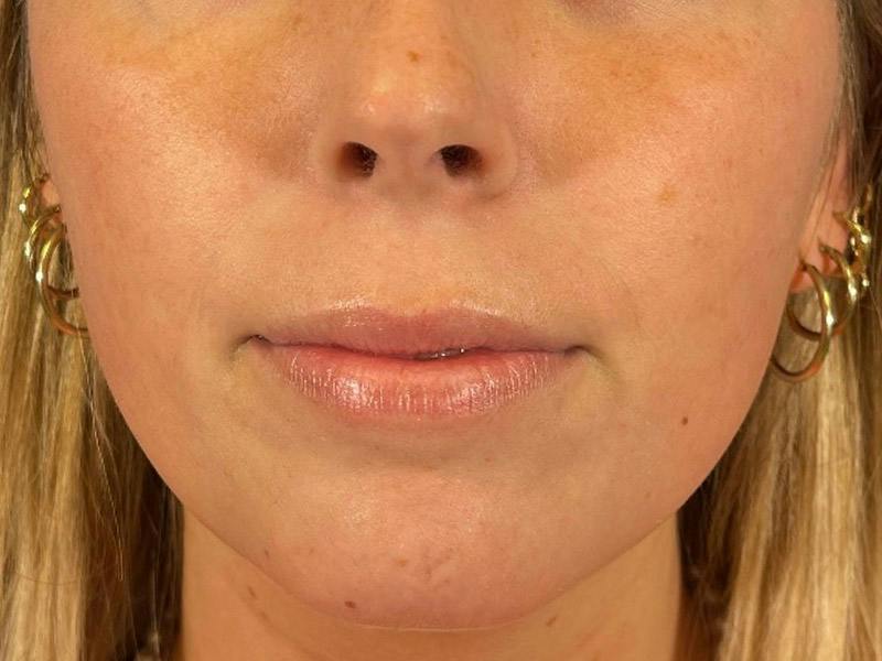 Lip Filler Before & After Gallery - Patient 369099 - Image 1