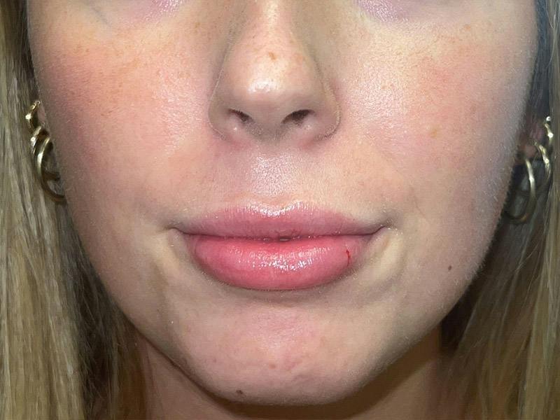 Lip Filler Before & After Gallery - Patient 369099 - Image 2