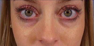 Under Eye Filler Before & After Gallery - Patient 160556 - Image 1