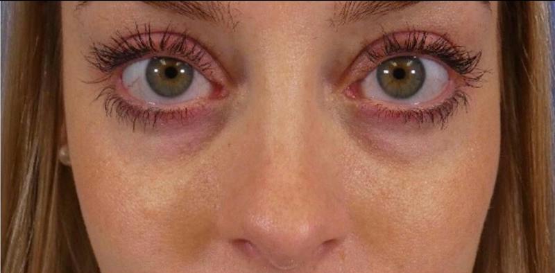 Under Eye Filler Before & After Gallery - Patient 160556 - Image 1