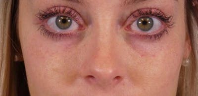 Under Eye Filler Before & After Gallery - Patient 160556 - Image 2