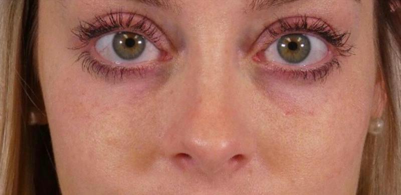 Under Eye Filler Before & After Gallery - Patient 160556 - Image 2