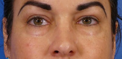 Under Eye Filler Before & After Gallery - Patient 155012 - Image 1