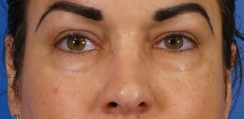 Under Eye Filler Before & After Gallery - Patient 155012 - Image 1