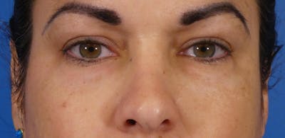 Under Eye Filler Before & After Gallery - Patient 155012 - Image 2