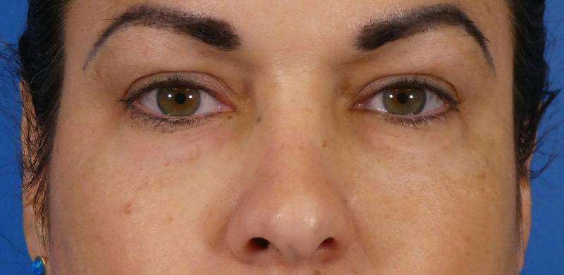 Under Eye Filler Before & After Gallery - Patient 155012 - Image 2