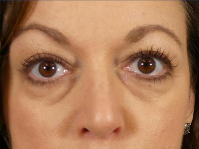 Under Eye Filler Before & After Gallery - Patient 115948 - Image 1