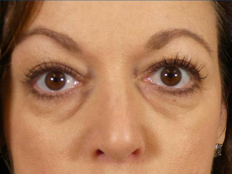 Under Eye Filler Before & After Gallery - Patient 115948 - Image 1