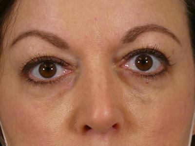 Under Eye Filler Before & After Gallery - Patient 115948 - Image 2