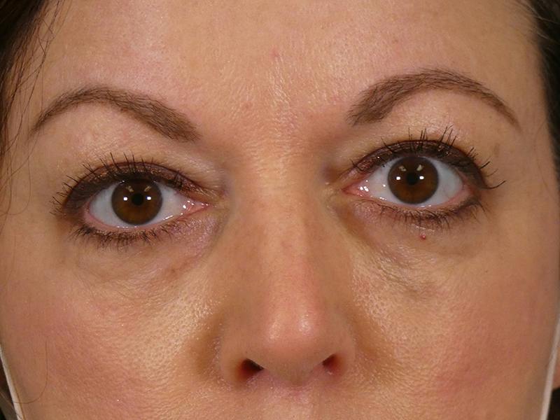 Under Eye Filler Before & After Gallery - Patient 115948 - Image 2