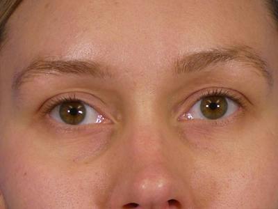 Under Eye Filler Before & After Gallery - Patient 398892 - Image 1