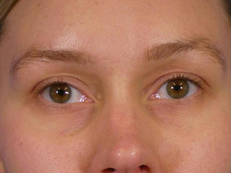 Under Eye Filler Before & After Gallery - Patient 398892 - Image 1