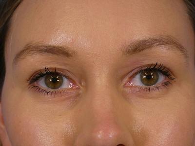 Under Eye Filler Before & After Gallery - Patient 398892 - Image 2