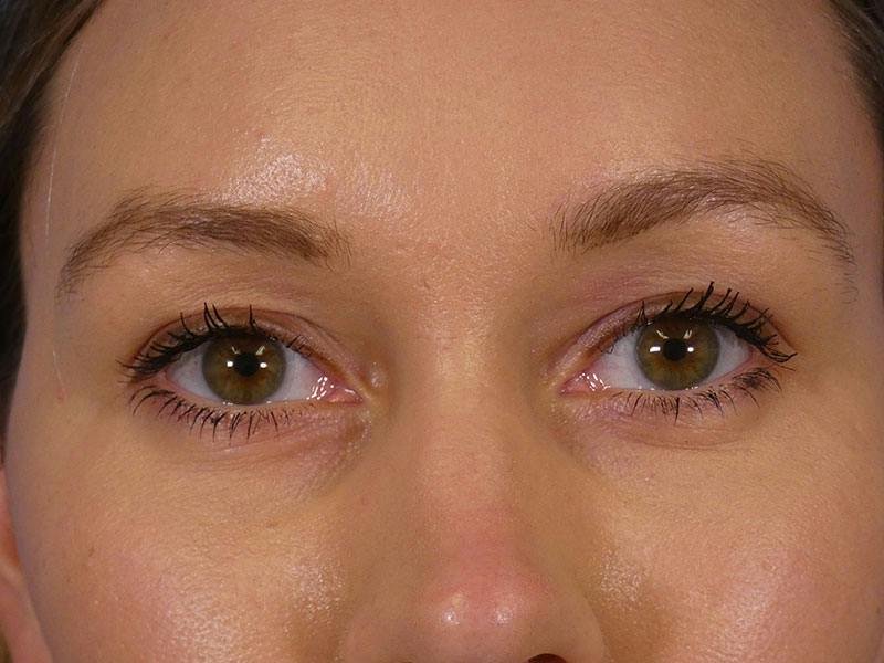 Under Eye Filler Before & After Gallery - Patient 398892 - Image 2
