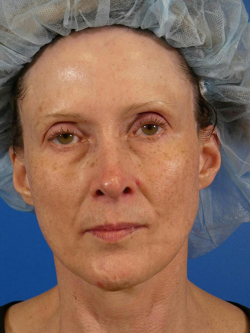 IPL Sun Spots Before & After Gallery - Patient 848741 - Image 1