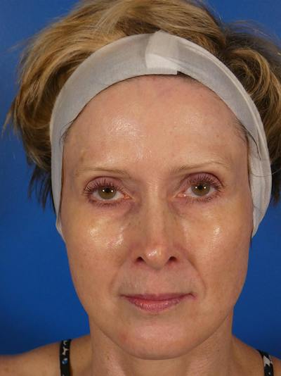 IPL Sun Spots Before & After Gallery - Patient 848741 - Image 2