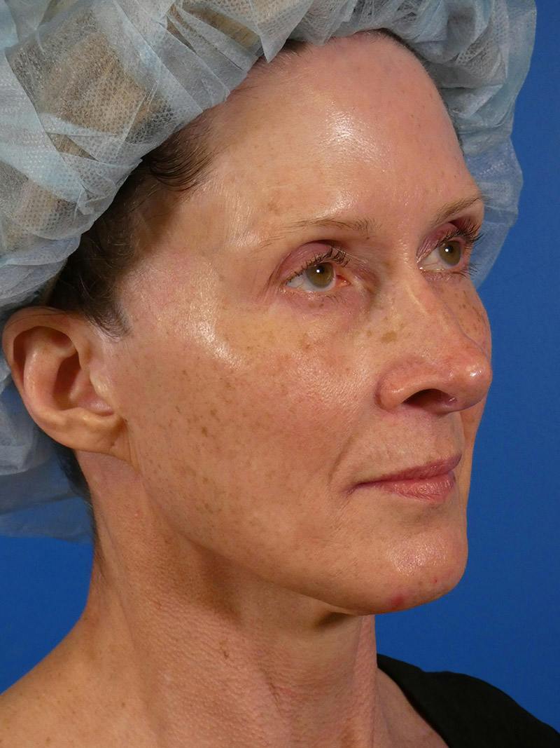 IPL Sun Spots Before & After Gallery - Patient 848741 - Image 3
