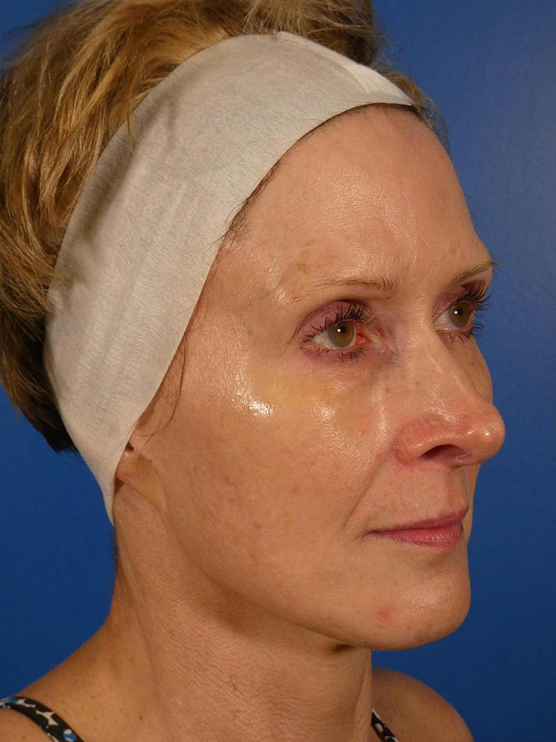 IPL Sun Spots Before & After Gallery - Patient 848741 - Image 4