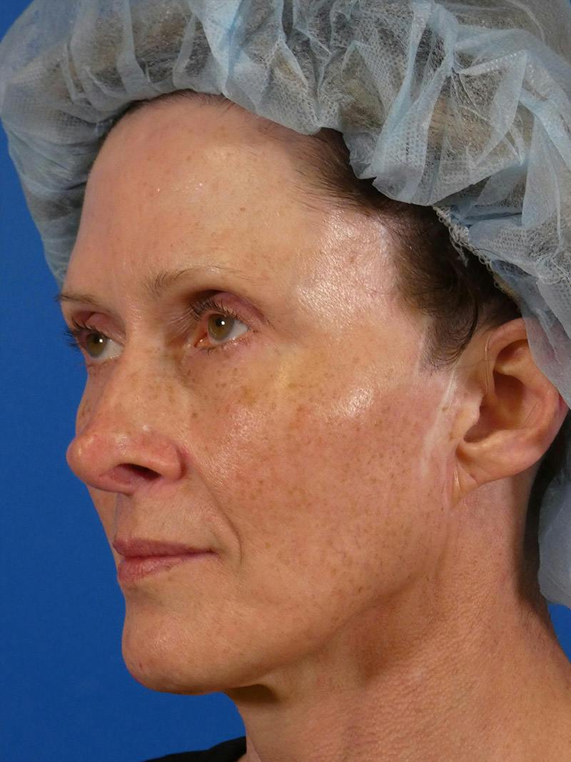 IPL Sun Spots Before & After Gallery - Patient 848741 - Image 5