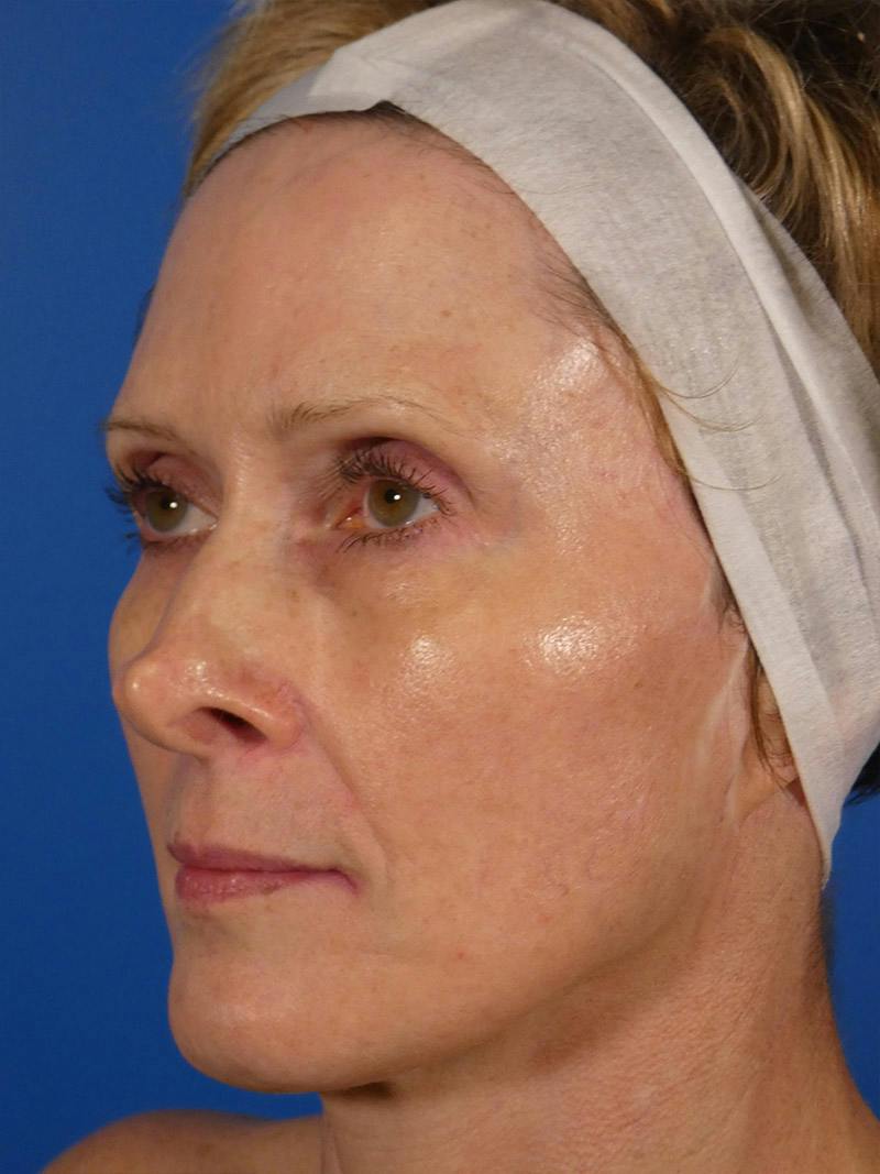 IPL Sun Spots Before & After Gallery - Patient 848741 - Image 6
