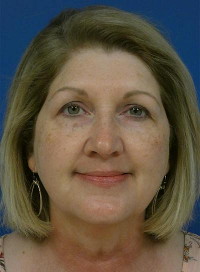 IPL Sun Spots Before & After Gallery - Patient 172688 - Image 1
