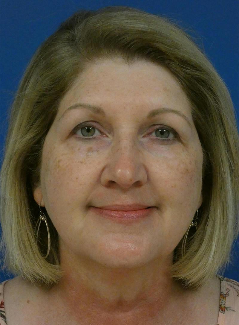 IPL Sun Spots Before & After Gallery - Patient 172688 - Image 1