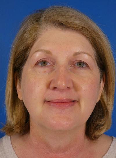 IPL Sun Spots Before & After Gallery - Patient 172688 - Image 2