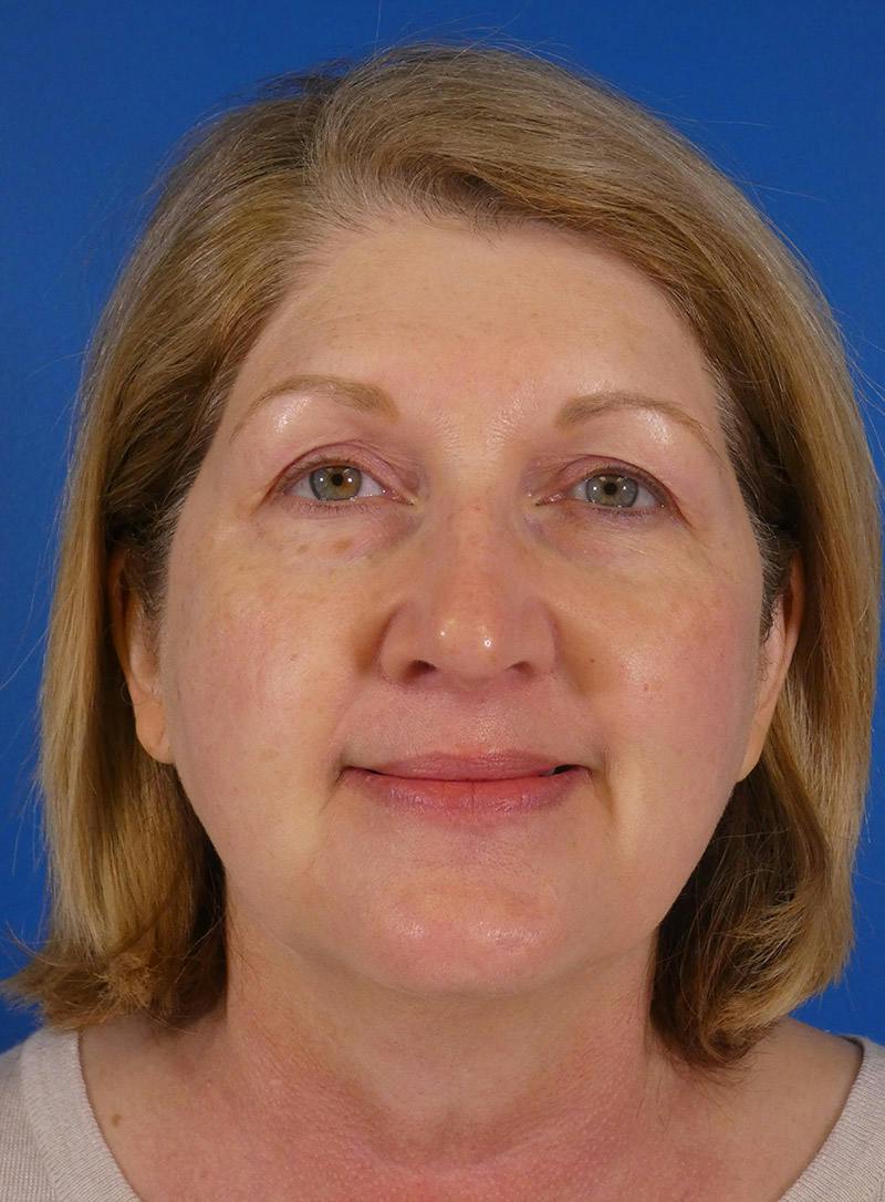 IPL Sun Spots Before & After Gallery - Patient 172688 - Image 2