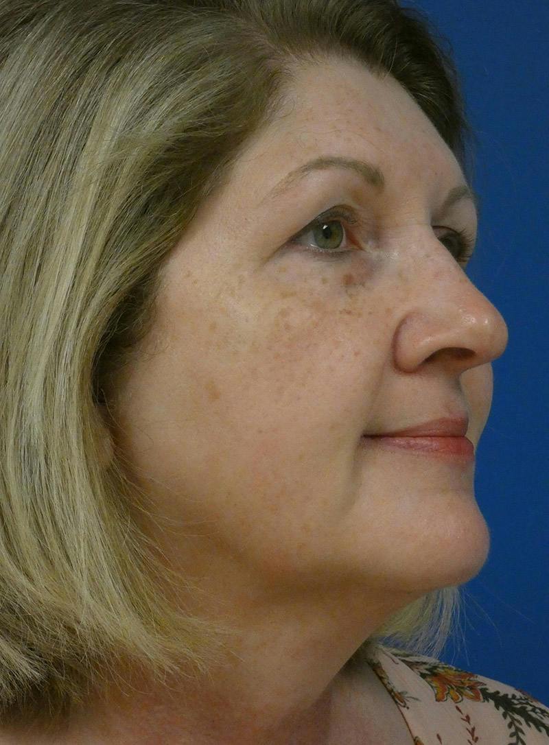 IPL Sun Spots Before & After Gallery - Patient 172688 - Image 3