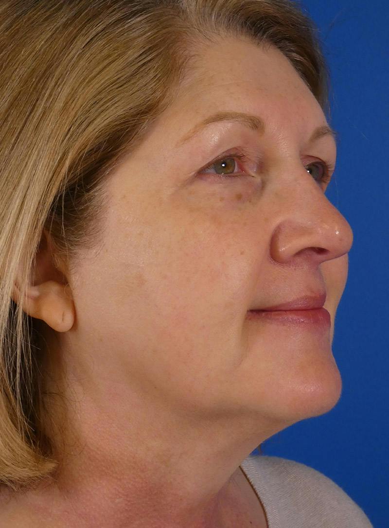 IPL Sun Spots Before & After Gallery - Patient 172688 - Image 4