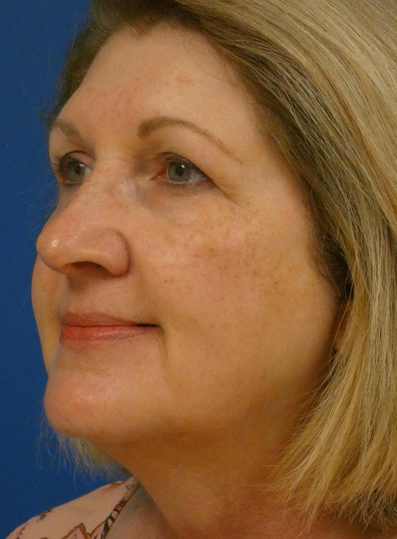 IPL Sun Spots Before & After Gallery - Patient 172688 - Image 5
