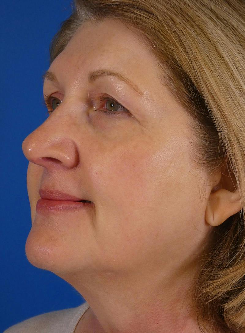 IPL Sun Spots Before & After Gallery - Patient 172688 - Image 6