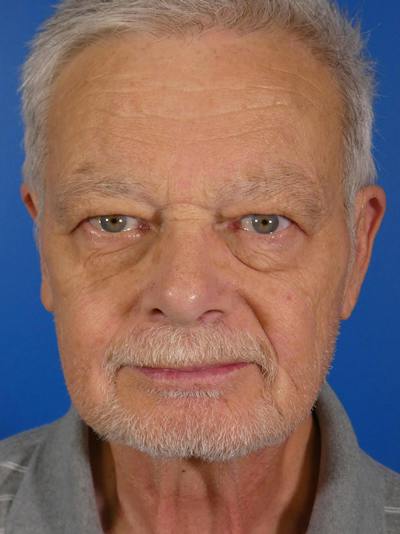 IPL Sun Spots Before & After Gallery - Patient 266883 - Image 2