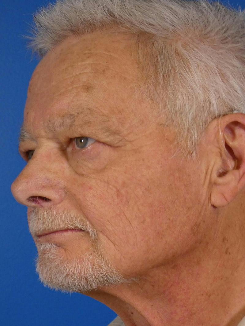 IPL Sun Spots Before & After Gallery - Patient 266883 - Image 5