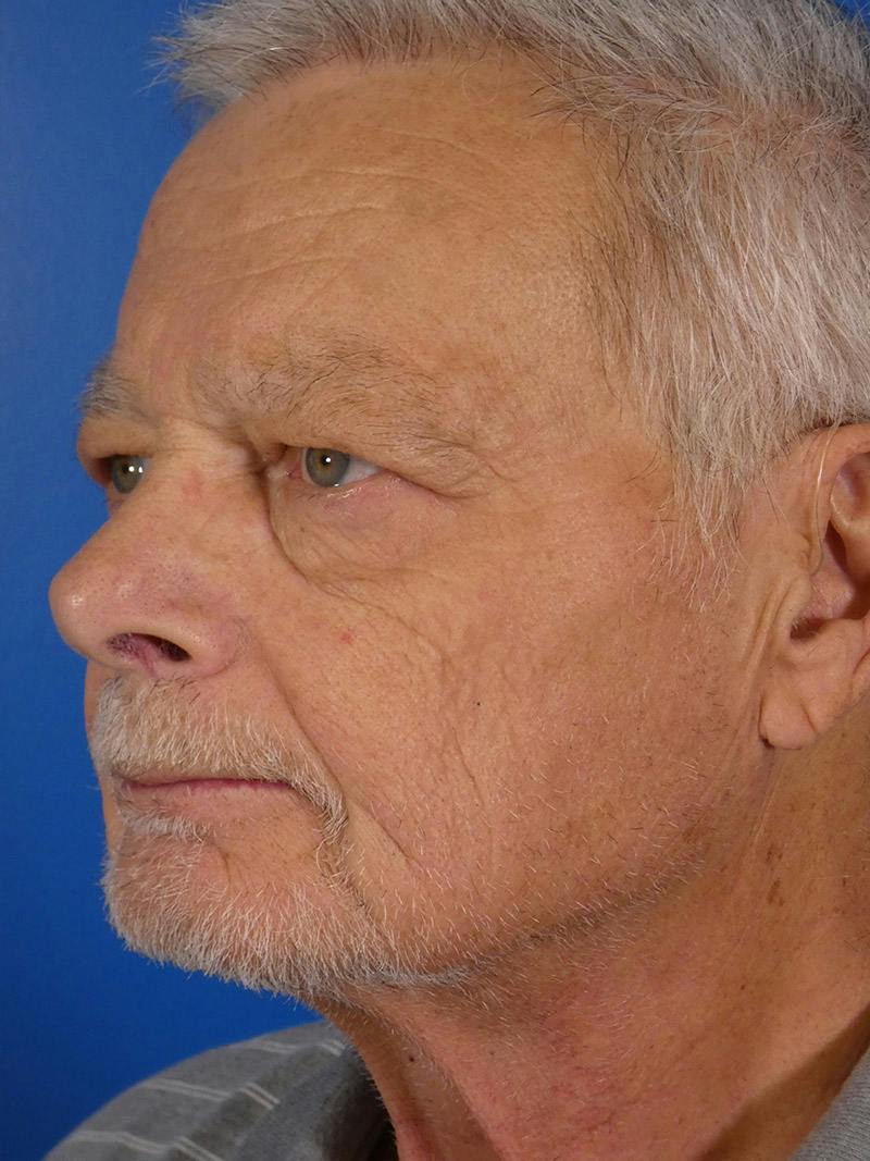 IPL Sun Spots Before & After Gallery - Patient 266883 - Image 6