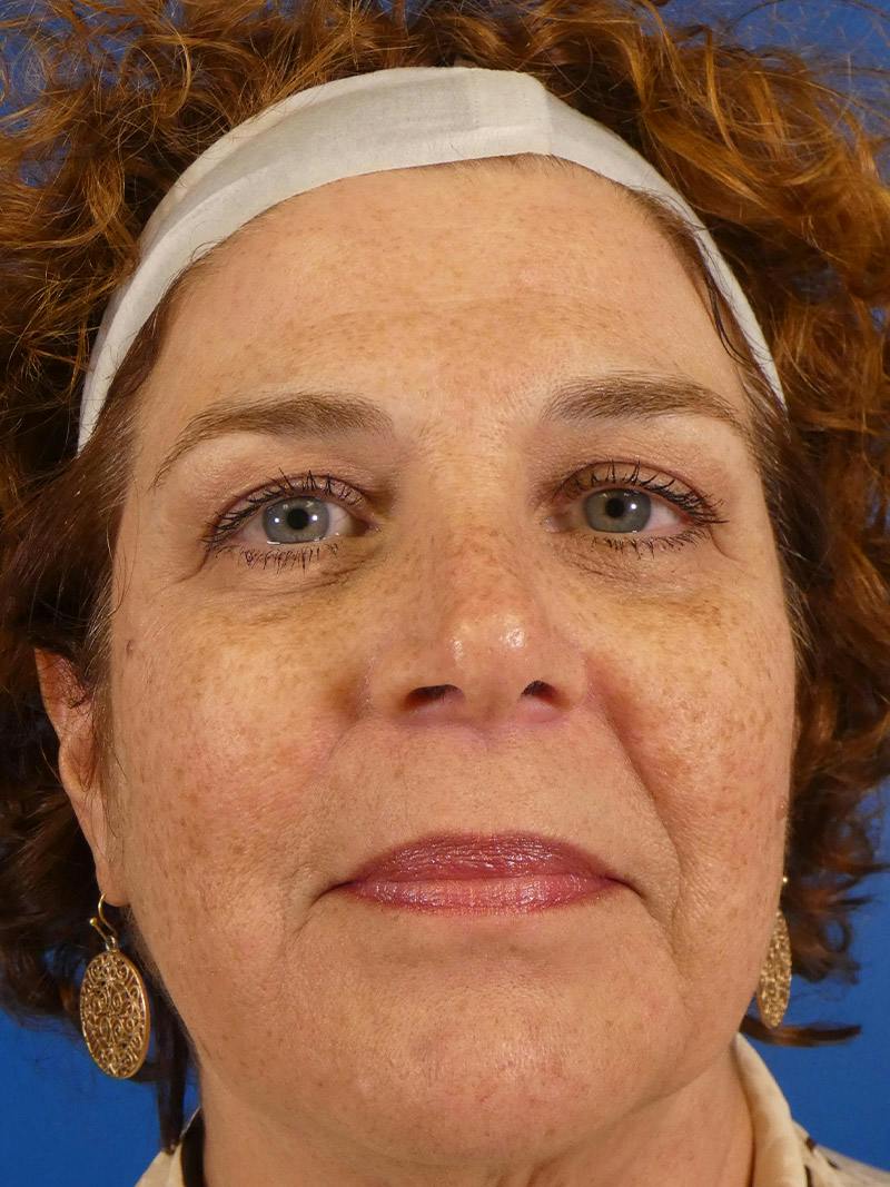 IPL Sun Spots Before & After Gallery - Patient 104624 - Image 1