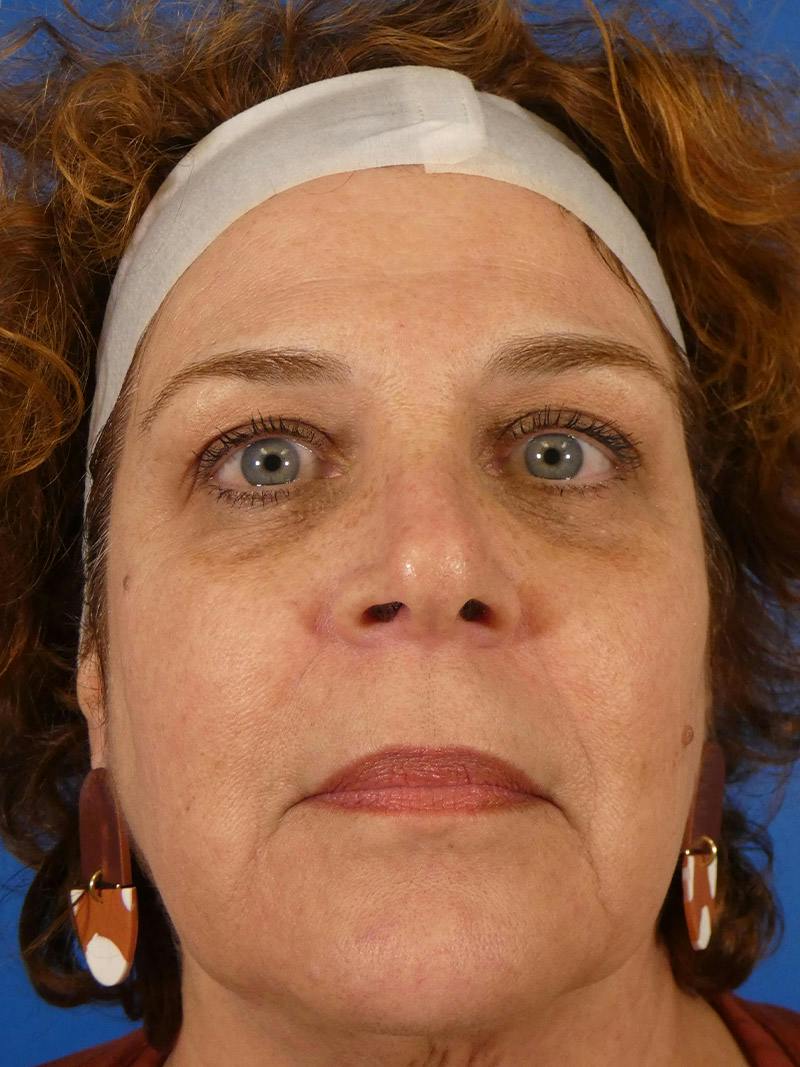 IPL Sun Spots Before & After Gallery - Patient 104624 - Image 2
