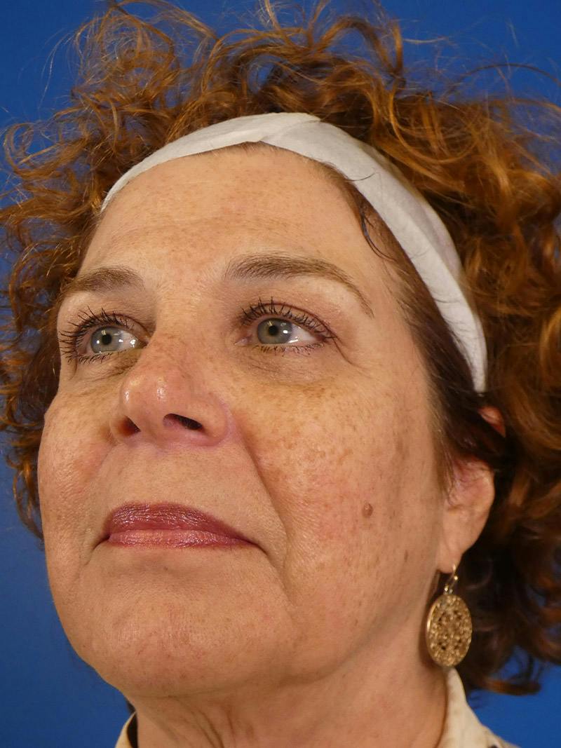 IPL Sun Spots Before & After Gallery - Patient 104624 - Image 3