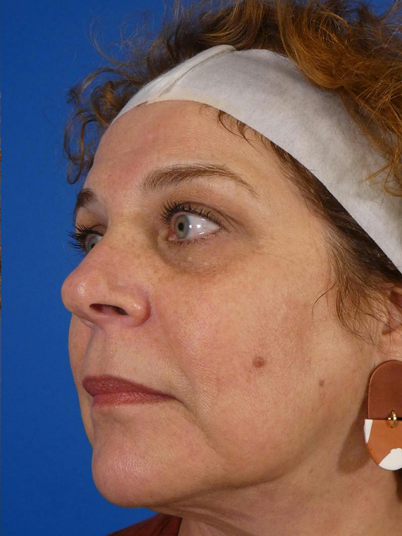 IPL Sun Spots Before & After Gallery - Patient 104624 - Image 4
