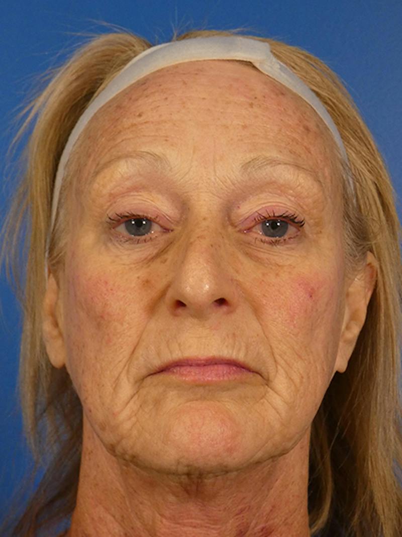 Microneedling Before & After Gallery - Patient 828776 - Image 1