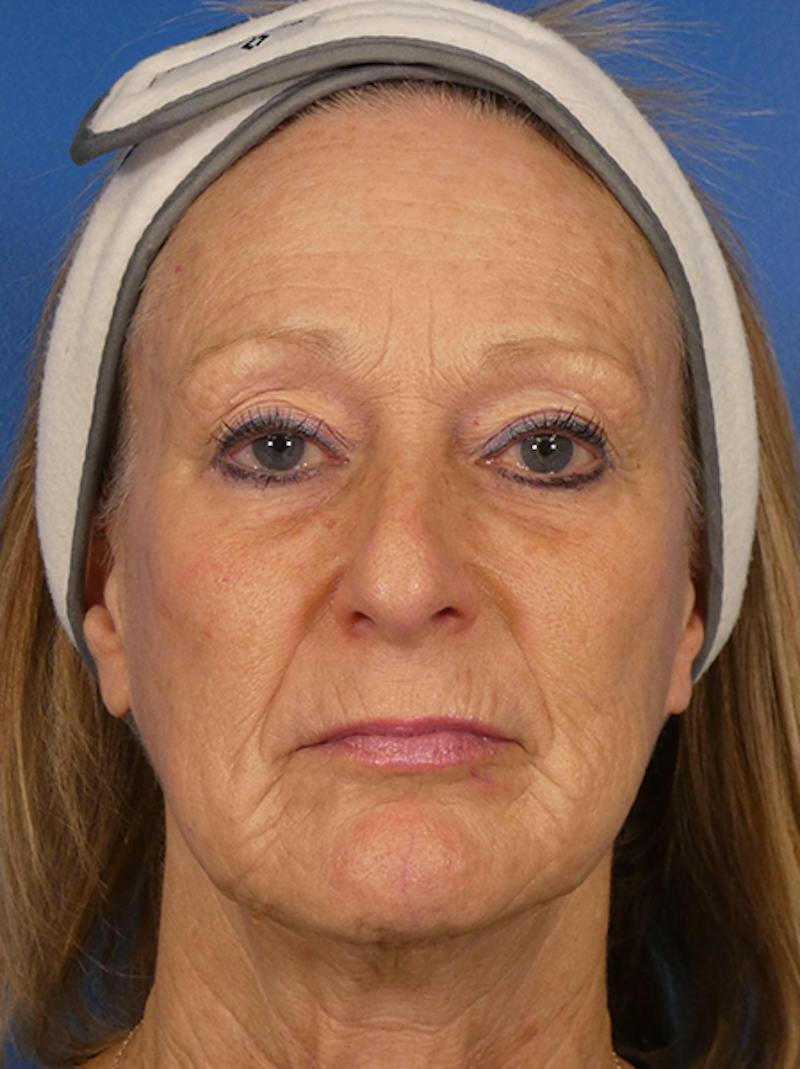 Microneedling Before & After Gallery - Patient 828776 - Image 2