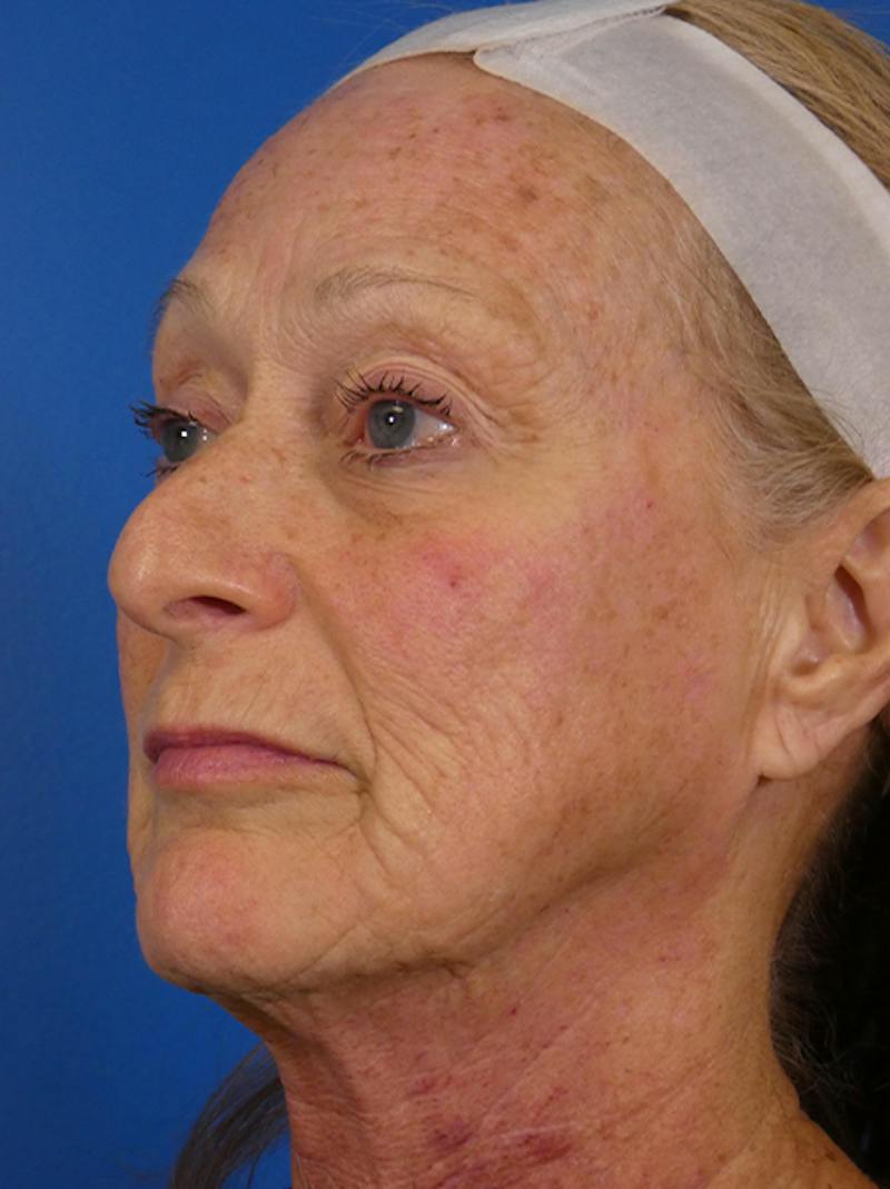Microneedling Before & After Gallery - Patient 828776 - Image 3