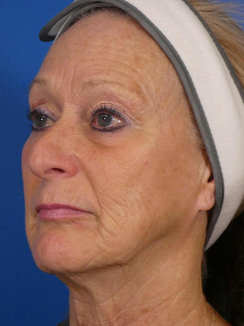 Microneedling Before & After Gallery - Patient 828776 - Image 4