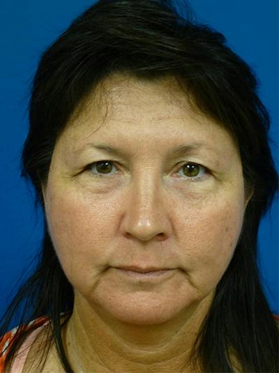 Microneedling Before & After Gallery - Patient 520057 - Image 1