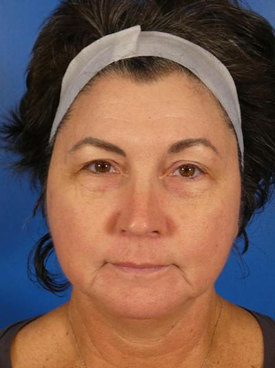 Microneedling Before & After Gallery - Patient 520057 - Image 2