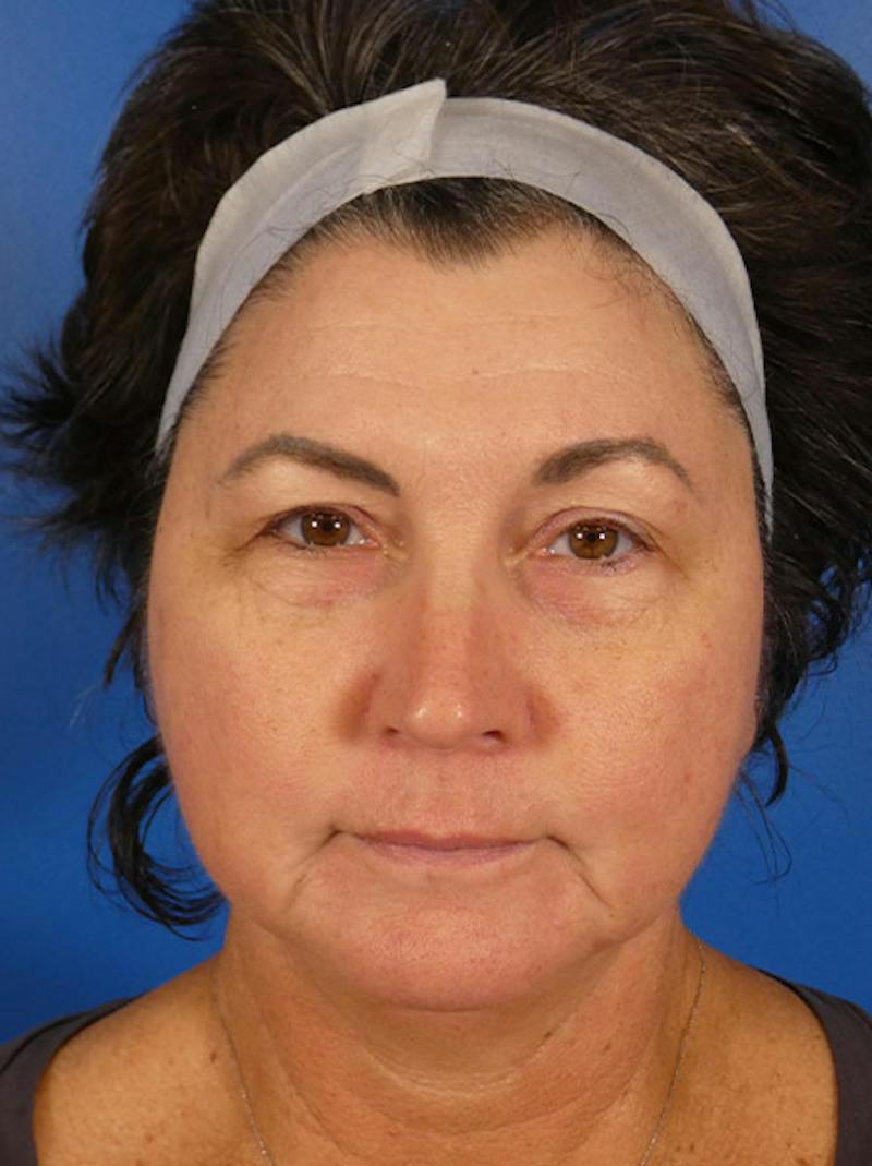 Microneedling Before & After Gallery - Patient 520057 - Image 2