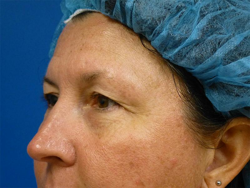 Microneedling Before & After Gallery - Patient 520057 - Image 3