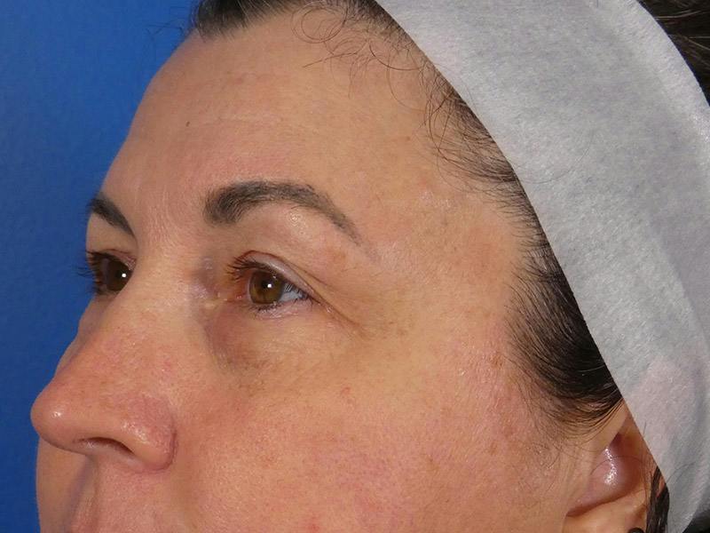 Microneedling Before & After Gallery - Patient 520057 - Image 4